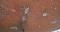 Kwashiorkor: Causes, Symptoms, and Diagnosis