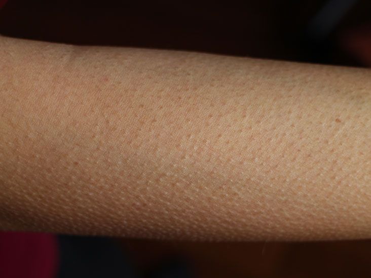 Goosebumps on the Skin: Causes and Symptoms